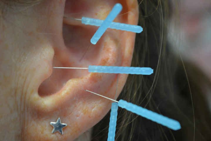 Akupunkturnadeln in der Anwendung - Ohrakupunktur