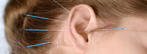 Nadeln im Ohr - Akupunktur am Ohr